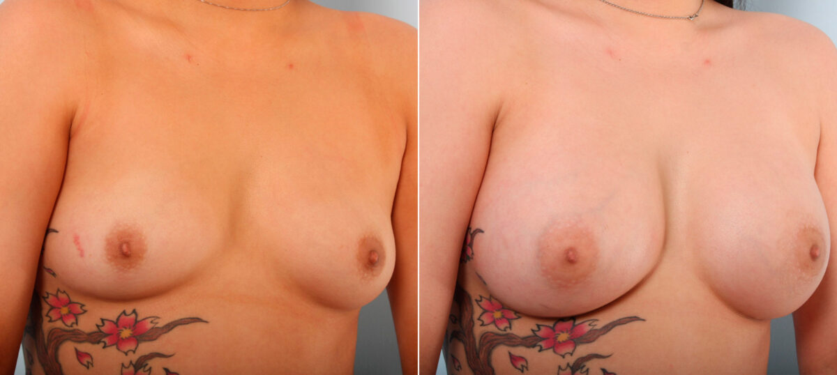 Breast Augmentation before and after photos in Houston, TX, Patient 41581