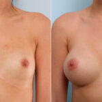 Breast Augmentation before and after photos in Houston, TX, Patient 41602