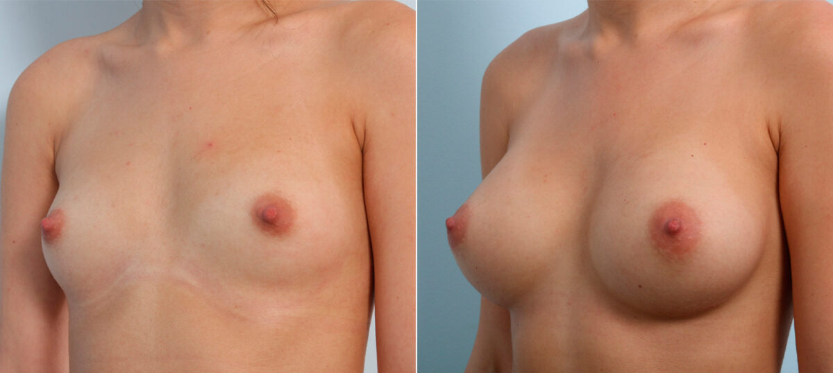 Breast Augmentation before and after photos in Houston, TX, Patient 41602