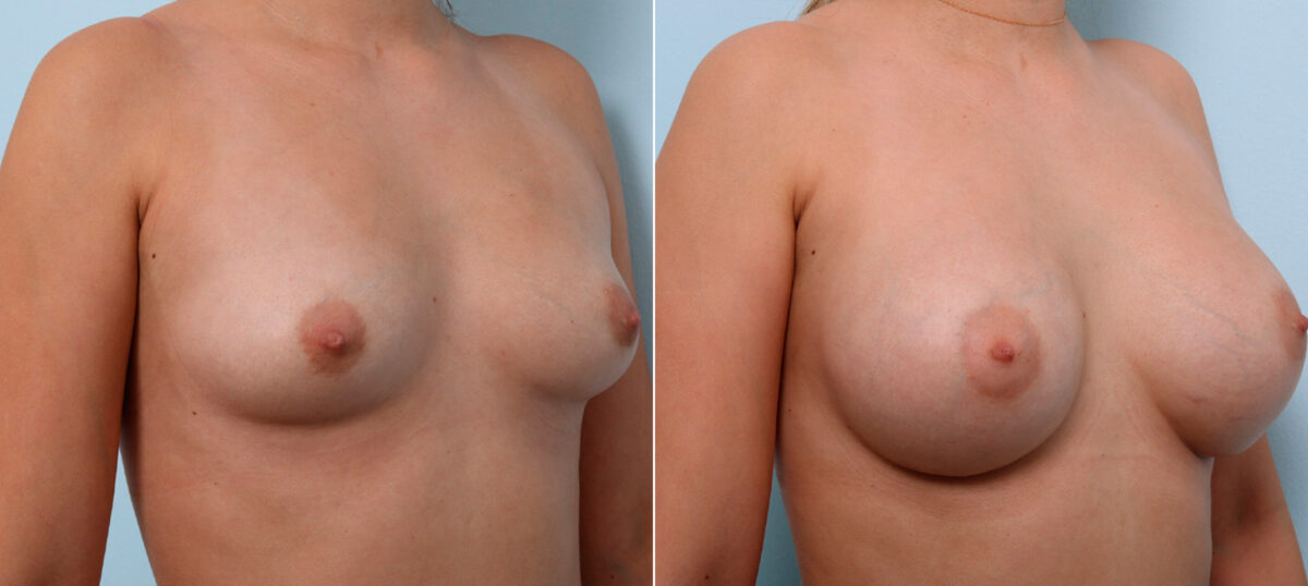 Breast Augmentation before and after photos in Houston, TX, Patient 41623