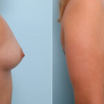 Breast Augmentation before and after photos in Houston, TX, Patient 41623