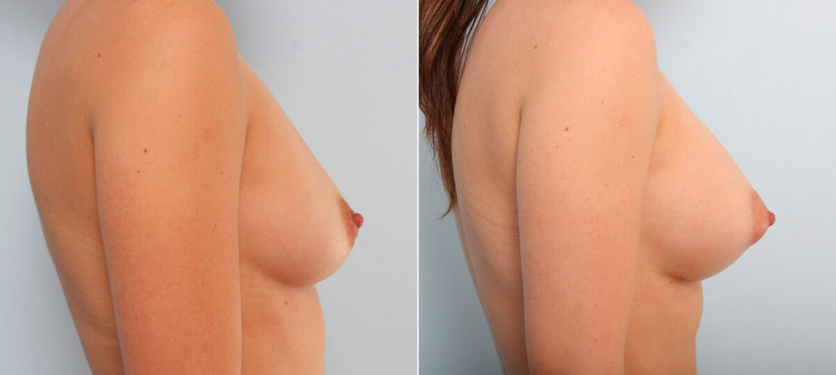 Breast Augmentation before and after photos in Houston, TX, Patient 41644