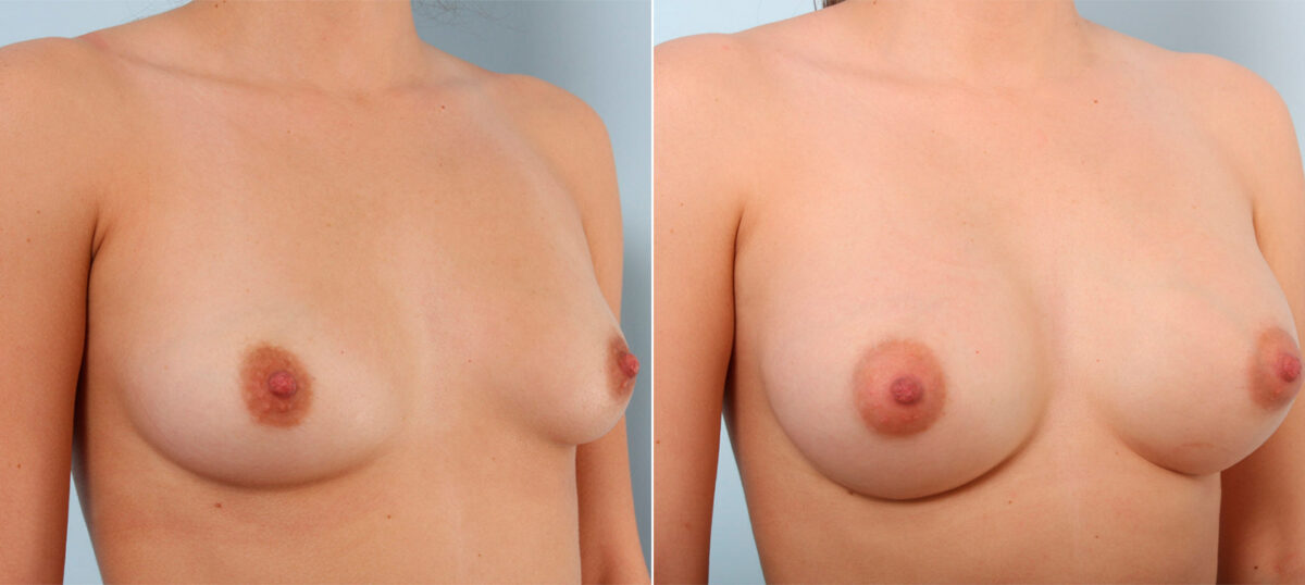 Breast Augmentation before and after photos in Houston, TX, Patient 41644