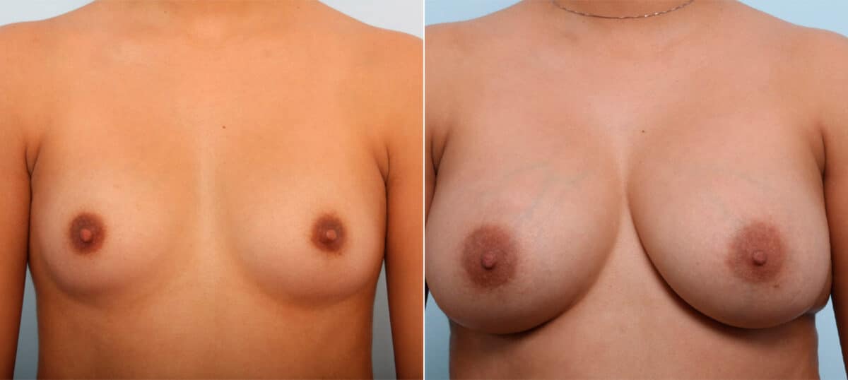 Breast Augmentation before and after photos in Houston, TX, Patient 41686