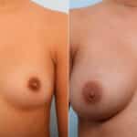 Breast Augmentation before and after photos in Houston, TX, Patient 41686