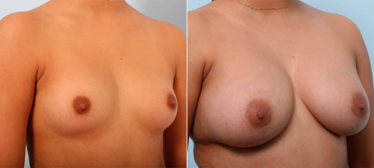 Breast Augmentation before and after photos in Houston, TX, Patient 41686