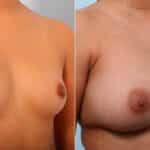 Breast Augmentation before and after photos in Houston, TX, Patient 41686