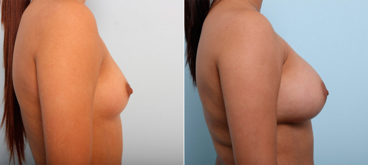 Breast Augmentation before and after photos in Houston, TX, Patient 41686