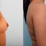 Breast Augmentation before and after photos in Houston, TX, Patient 41686