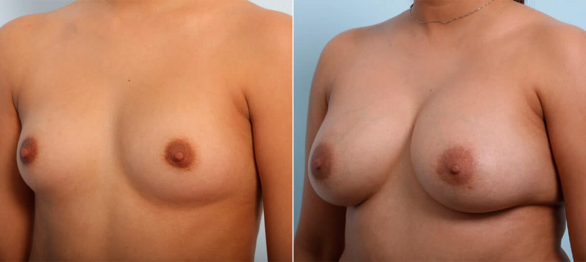 Breast Augmentation before and after photos in Houston, TX, Patient 41686