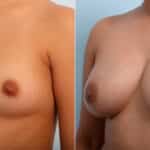 Breast Augmentation before and after photos in Houston, TX, Patient 41686