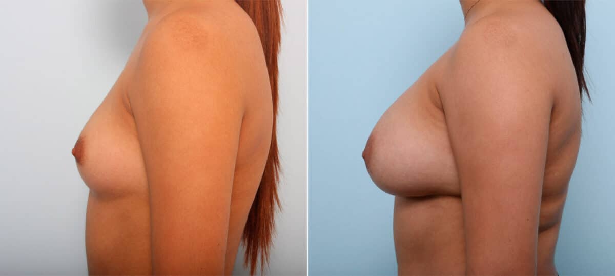 Breast Augmentation before and after photos in Houston, TX, Patient 41686