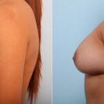 Breast Augmentation before and after photos in Houston, TX, Patient 41686