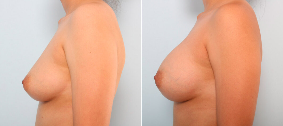 Breast Augmentation before and after photos in Houston, TX, Patient 41707