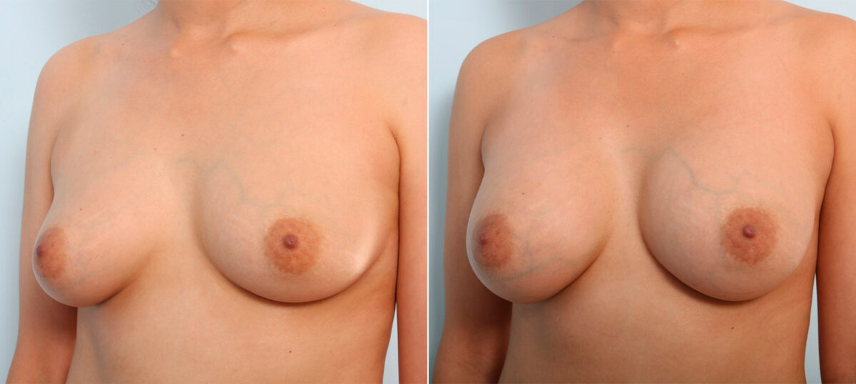 Breast Augmentation before and after photos in Houston, TX, Patient 41707