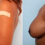Breast Augmentation before and after photos in Houston, TX, Patient 41728