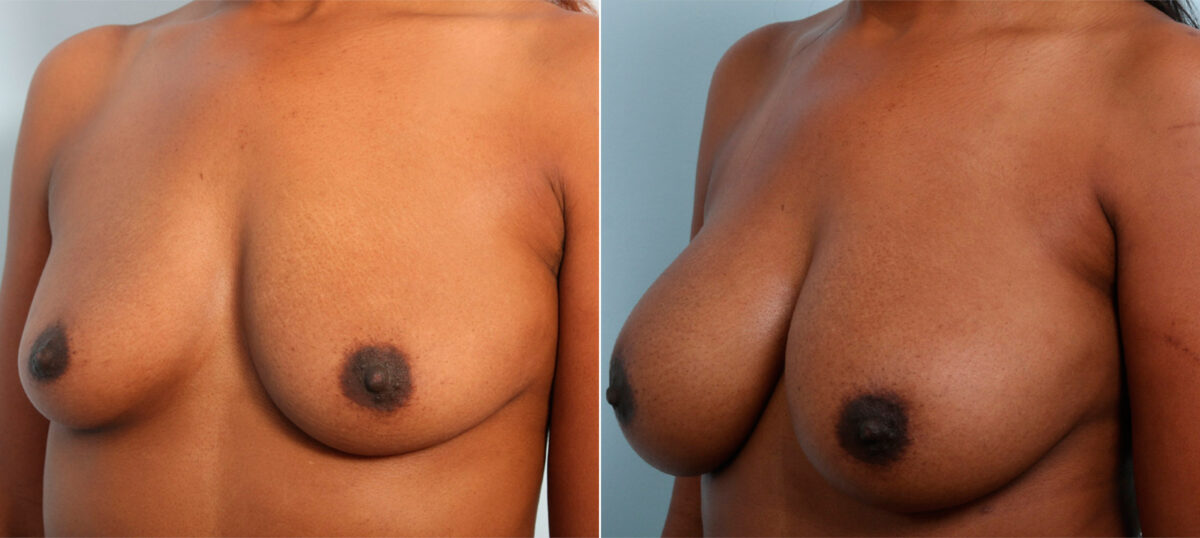 Breast Augmentation before and after photos in Houston, TX, Patient 41728