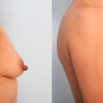 Breast Augmentation before and after photos in Houston, TX, Patient 41749