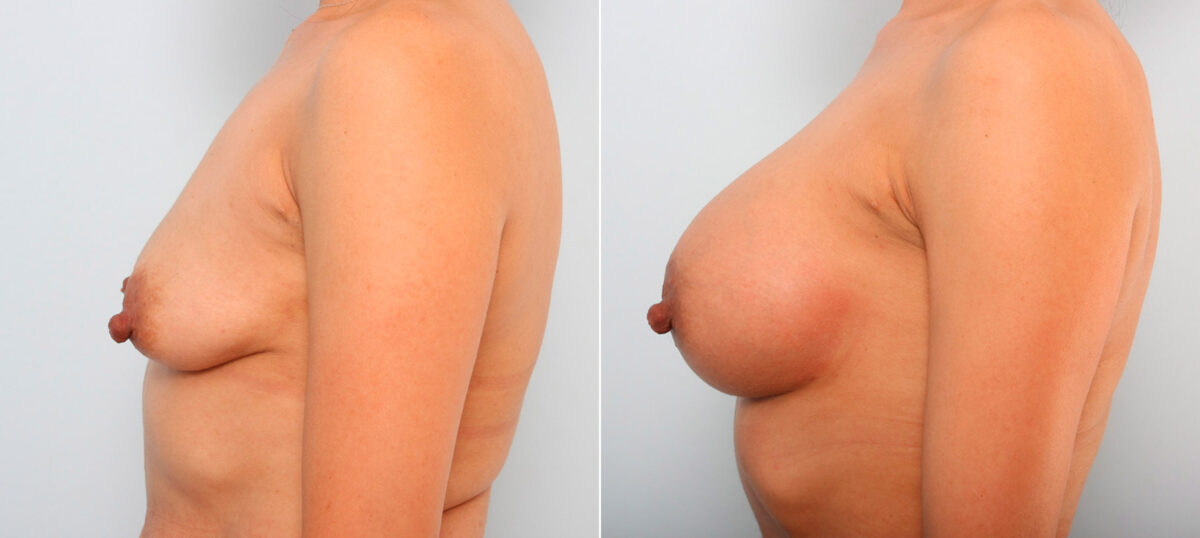 Breast Augmentation before and after photos in Houston, TX, Patient 41749