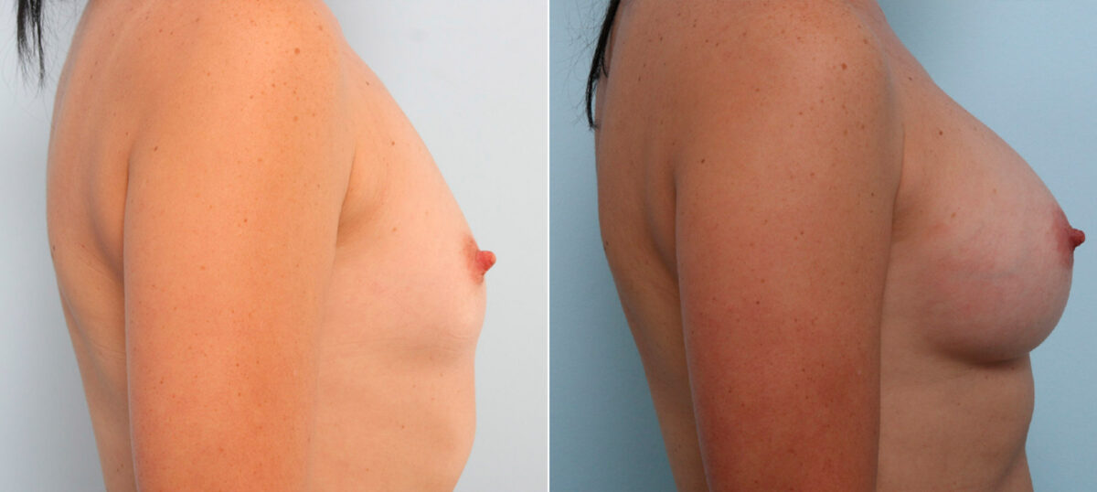 Breast Augmentation before and after photos in Houston, TX, Patient 41771