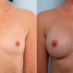 Breast Augmentation before and after photos in Houston, TX, Patient 41771