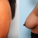 Breast Augmentation before and after photos in Houston, TX, Patient 41794