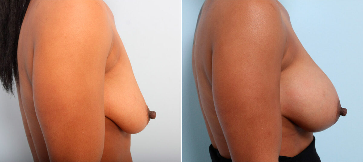Breast Augmentation before and after photos in Houston, TX, Patient 41794