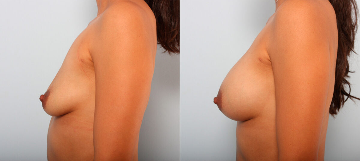 Breast Augmentation before and after photos in Houston, TX, Patient 41815