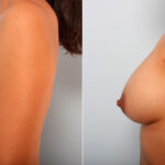 Breast Augmentation before and after photos in Houston, TX, Patient 41815