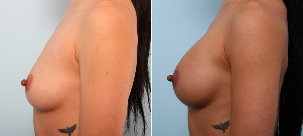 Breast Augmentation before and after photos in Houston, TX, Patient 41836