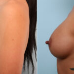Breast Augmentation before and after photos in Houston, TX, Patient 41836
