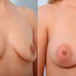 Breast Augmentation before and after photos in Houston, TX, Patient 41857