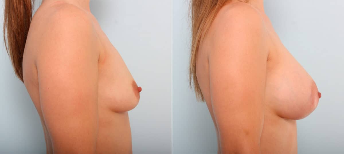 Breast Augmentation before and after photos in Houston, TX, Patient 41857