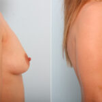 Breast Augmentation before and after photos in Houston, TX, Patient 41857