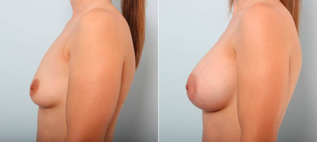 Breast Augmentation before and after photos in Houston, TX, Patient 41857