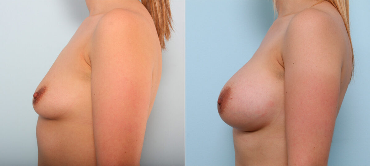 Breast Augmentation before and after photos in Houston, TX, Patient 41878