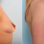 Breast Augmentation before and after photos in Houston, TX, Patient 41878