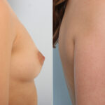 Breast Augmentation before and after photos in Houston, TX, Patient 41899