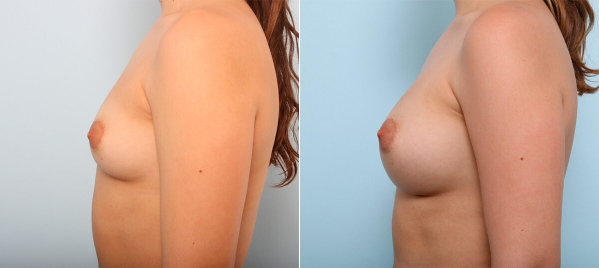 Breast Augmentation before and after photos in Houston, TX, Patient 41899