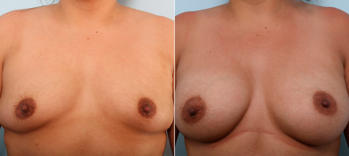 Breast Augmentation before and after photos in Houston, TX, Patient 41920