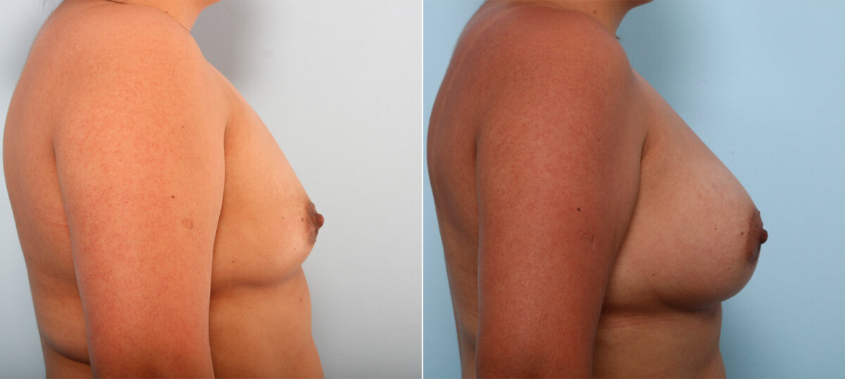 Breast Augmentation before and after photos in Houston, TX, Patient 41920