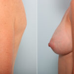 Breast Augmentation before and after photos in Houston, TX, Patient 41941