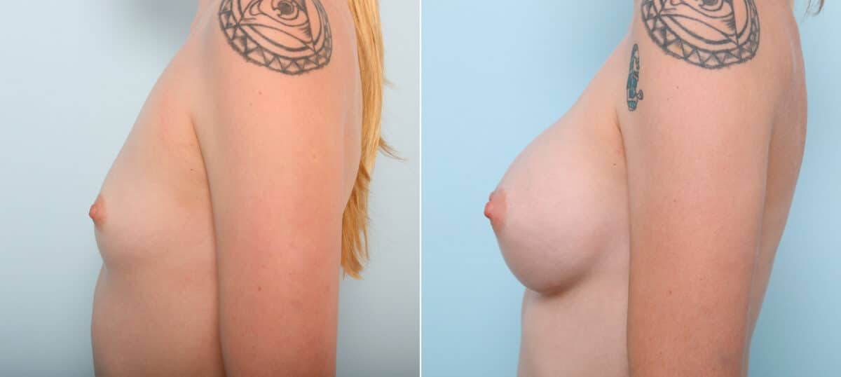 Breast Augmentation before and after photos in Houston, TX, Patient 41962