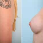 Breast Augmentation before and after photos in Houston, TX, Patient 41962