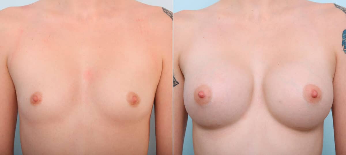 Breast Augmentation before and after photos in Houston, TX, Patient 41962