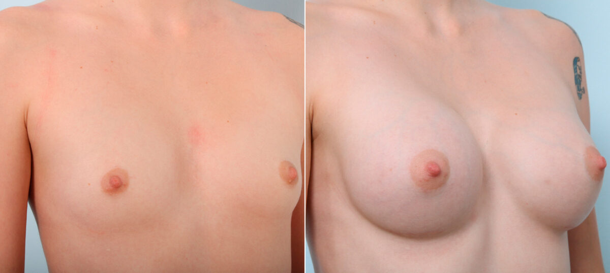 Breast Augmentation before and after photos in Houston, TX, Patient 41962