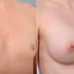 Breast Augmentation before and after photos in Houston, TX, Patient 41962