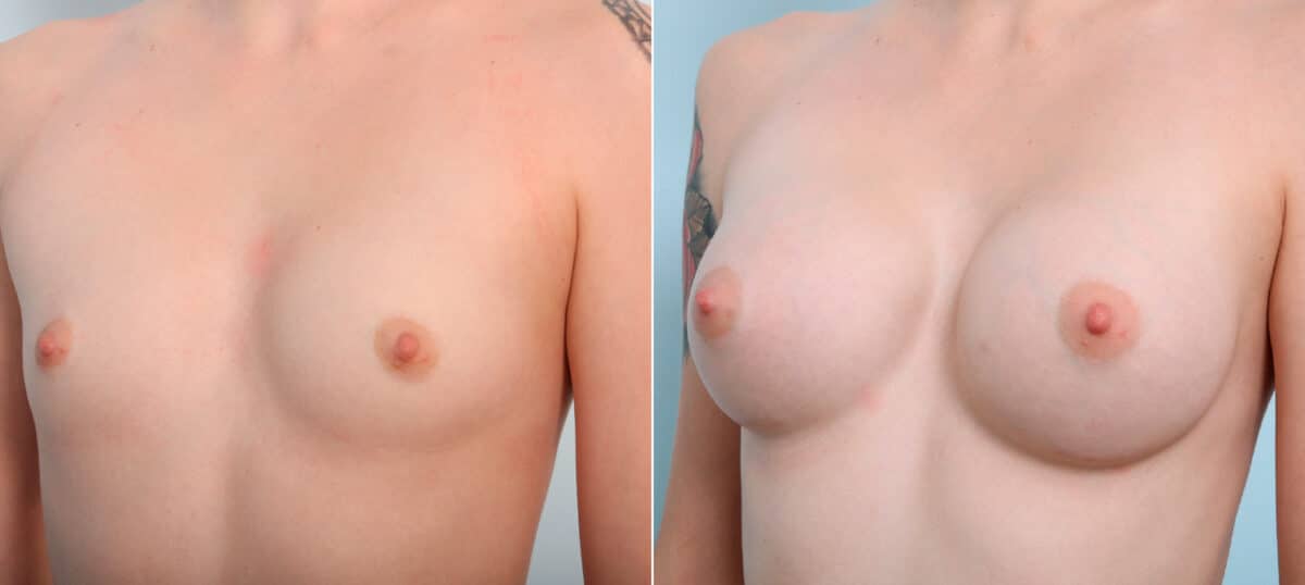 Breast Augmentation before and after photos in Houston, TX, Patient 41962