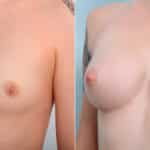 Breast Augmentation before and after photos in Houston, TX, Patient 41962