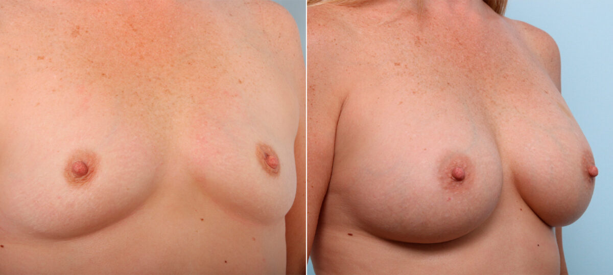 Breast Augmentation before and after photos in Houston, TX, Patient 41983